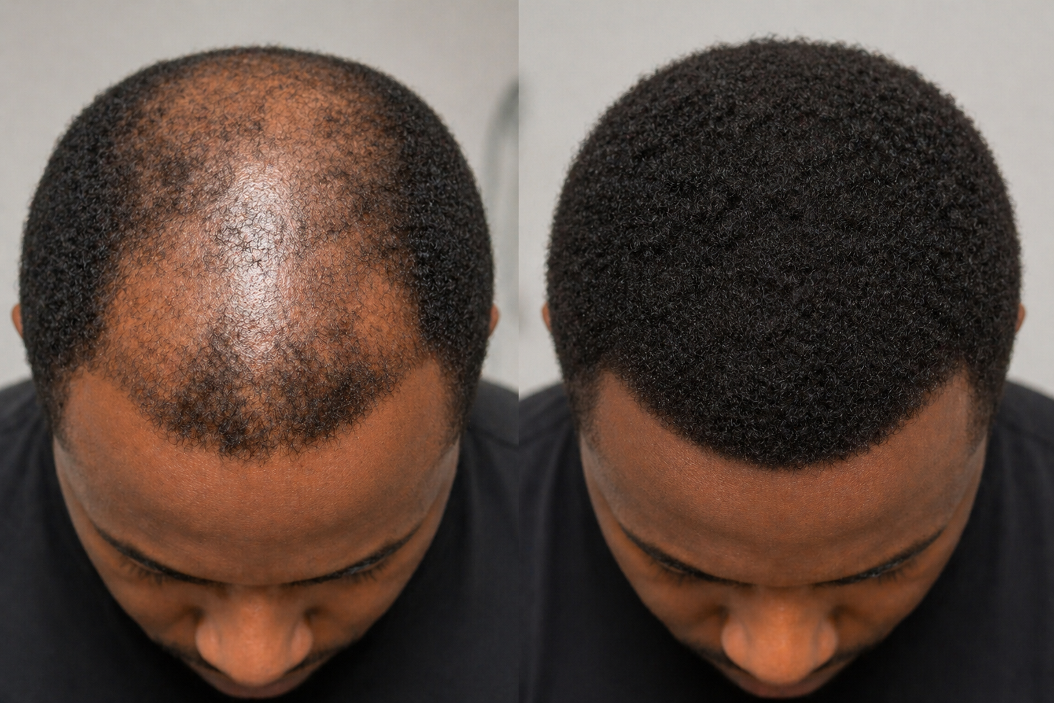 Hair Transplant